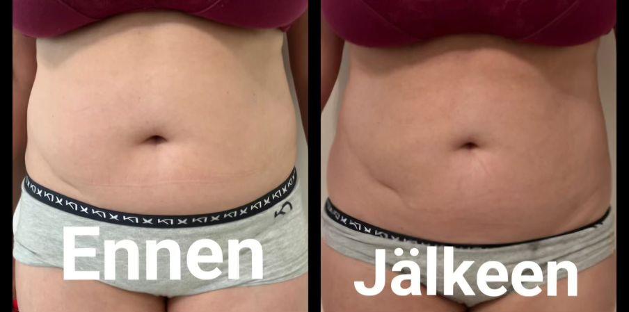 Clinic Hohde lipohifu ennenjälkeen